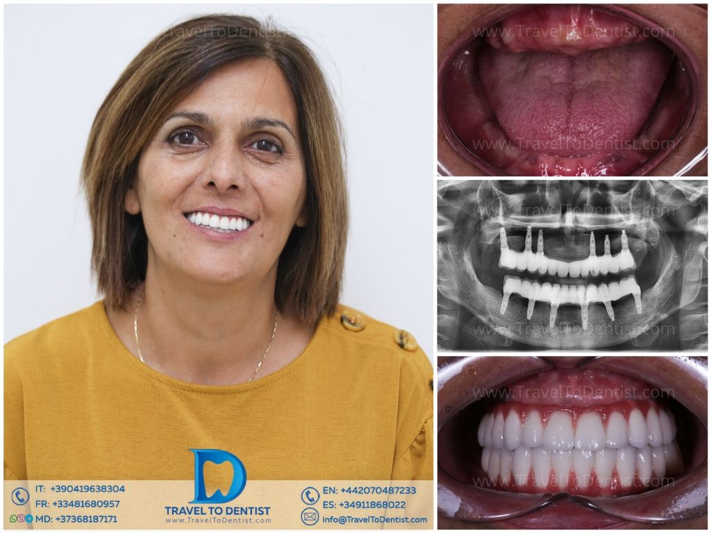 Resultados de tratamientos dentales